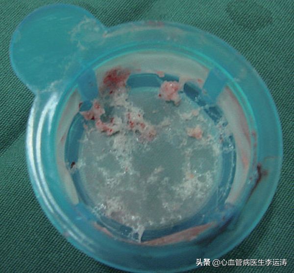 病人血小板低该吃什么药防治心梗,预防心梗复发阿司匹林用量