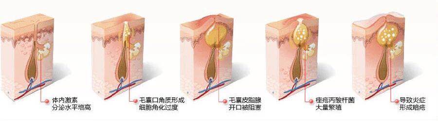 如何快速祛痘：痘痘分四个等级，你属于哪一级？