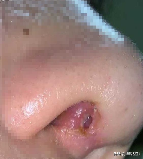 隆鼻失败的常见原因有哪些,隆鼻失败最快的解决方法