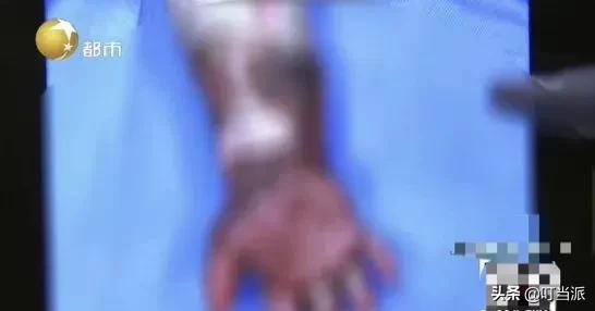 1岁娃被开水烫伤,几岁孩子大面积烫伤家长要注意