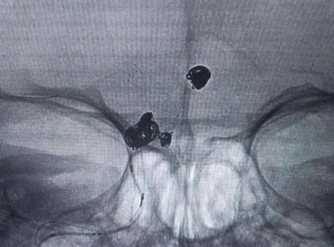 惊心动魄的心血管介入手术,脑动脉瘤开颅的全过程实例