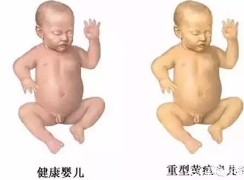 家有“小黄人”宝宝可不是闹着玩儿的!分清新生儿黄疸很重要