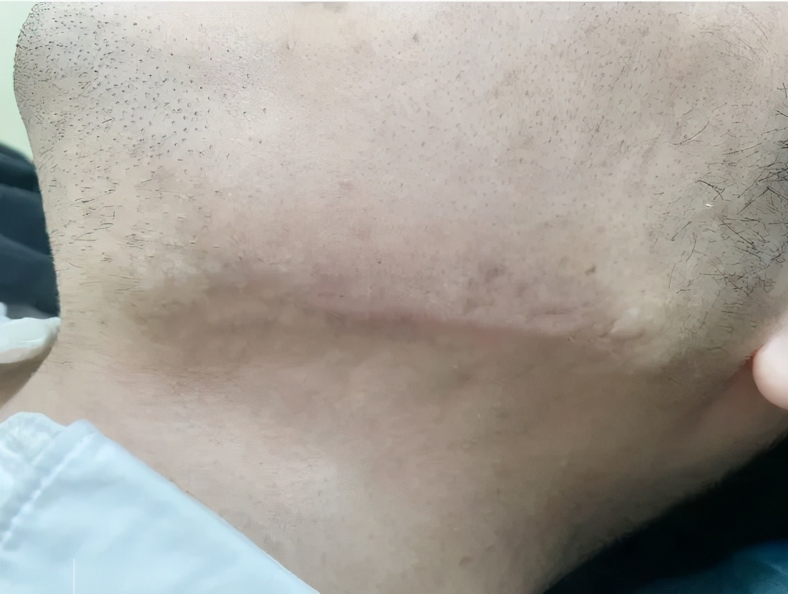 下颚痘痘反反复复是什么原因,下颌线上的痘痘反反复复怎么治