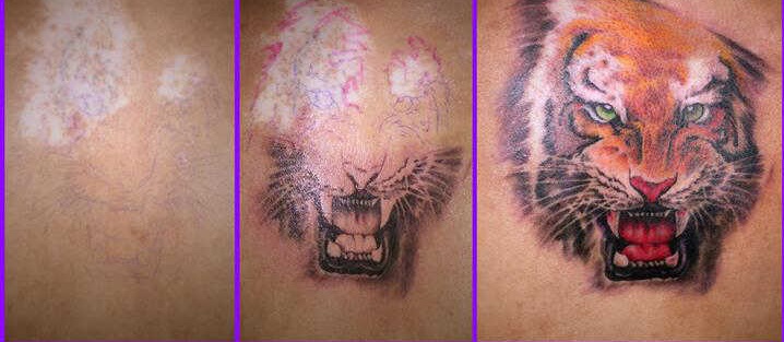 小块的白癜风能用纹身遮盖吗,白癜风用纹身能盖住吗