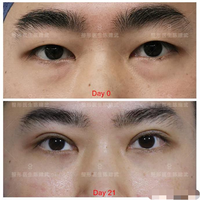 去眼袋泪沟医美方法,想了解一下去眼袋的最佳方法