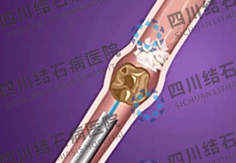 有尿结石可以报好医保吗,有结石非要做手术吗