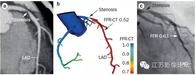 冠脉CT血管造影诊断高危斑块病变影像学特征分析