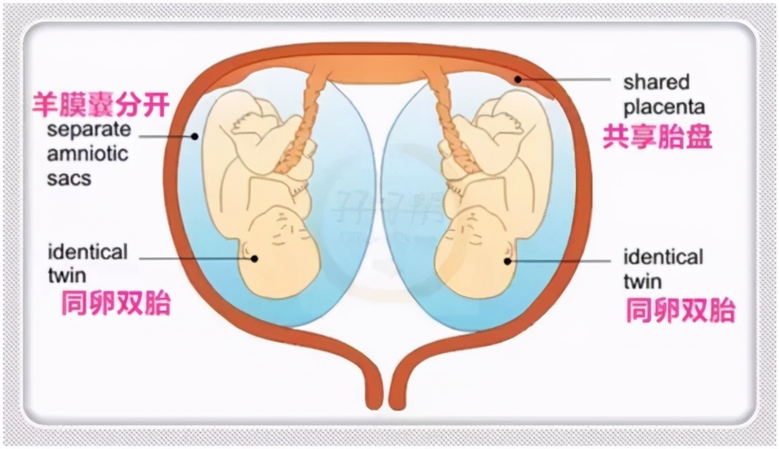 单绒双羊双胞胎医生会建议顺产吗,双羊双胞胎顺产吗