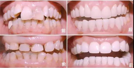 罗兰烤瓷牙,牙科最便宜的全瓷牙是什么品牌