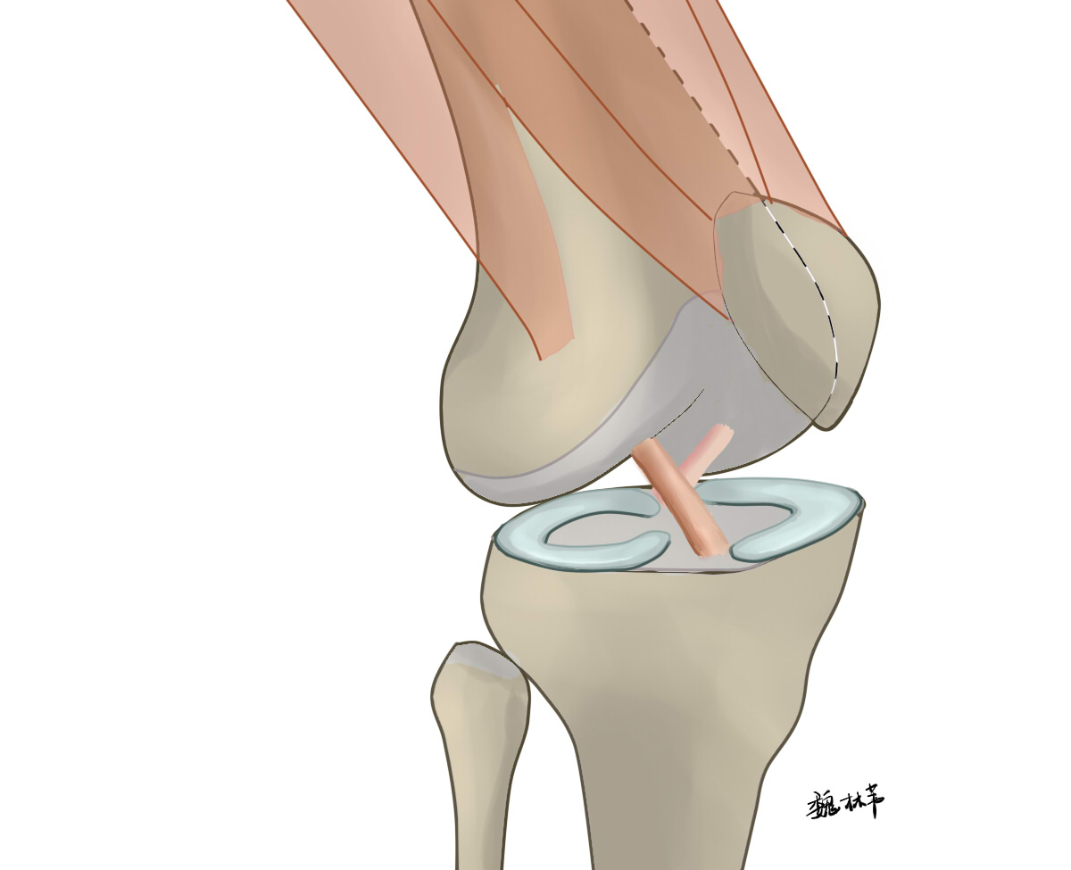 半月板缝合后复查核磁形态失常,半月板术后复查显示撕裂