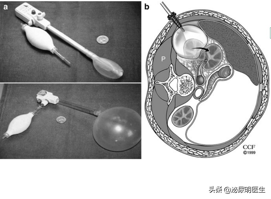 充分利用人体自然通道口鼻尿道肠道和阴道的内窥镜和腹腔镜技术