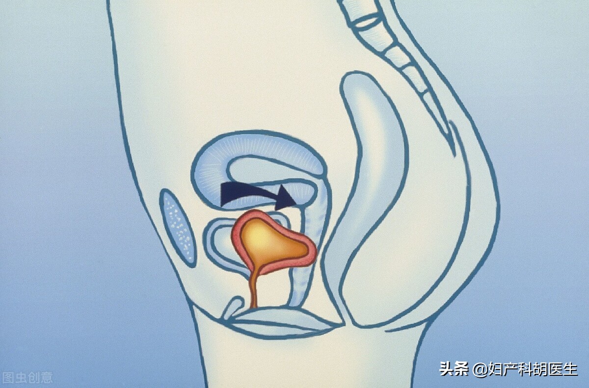 同房后尿频尿急尿痛，为何总是治不好？