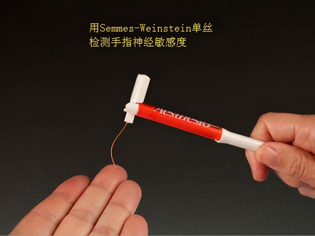 腕管综合征用什么办法诊断,腕管综合征鉴别诊断图片