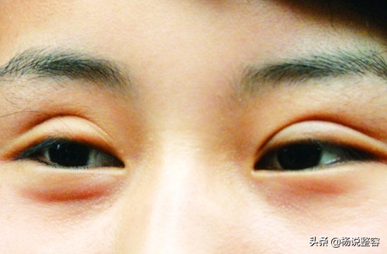 全切双眼皮是永久的么,全切双眼皮是永久吗