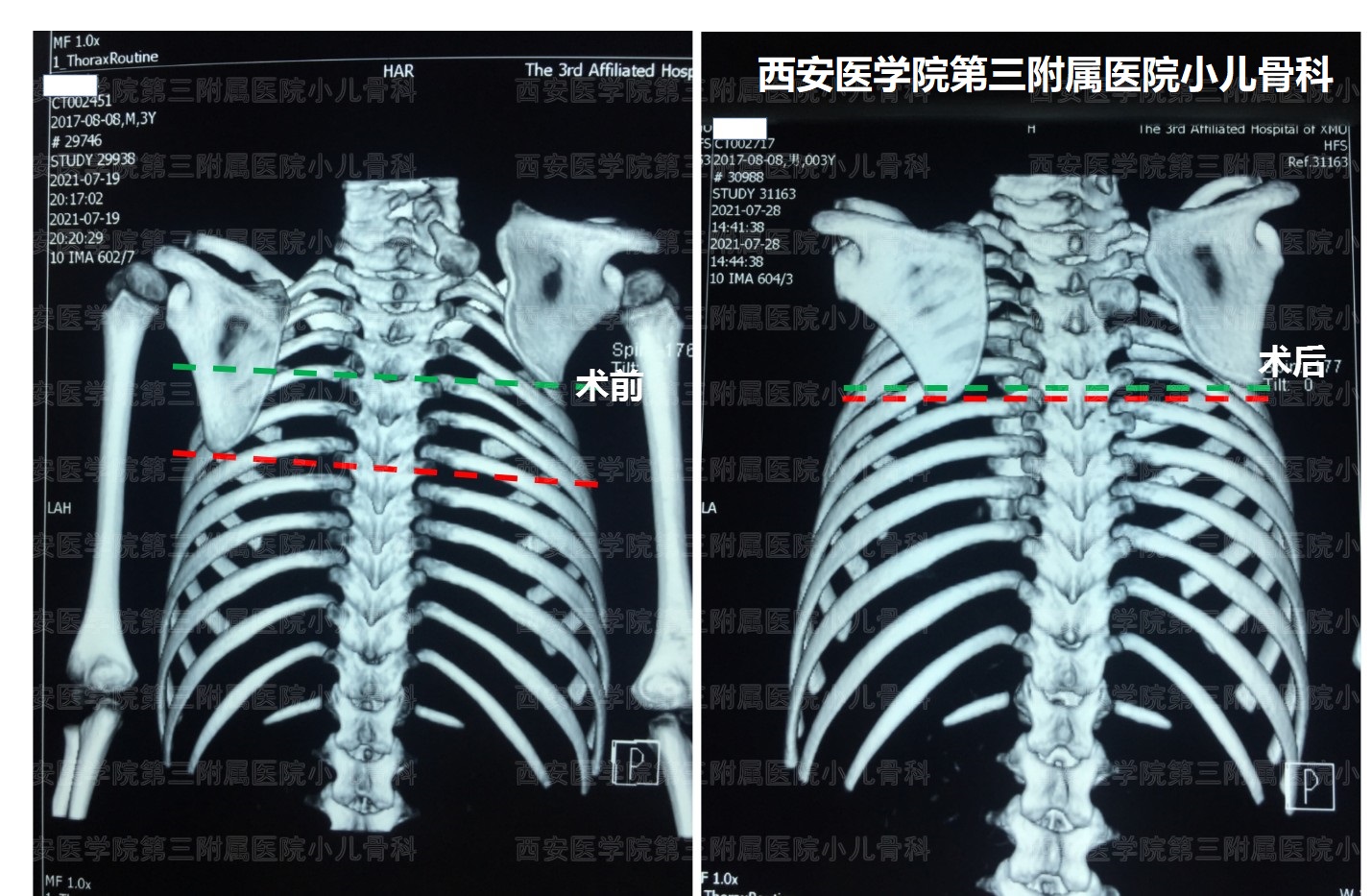 先天性高肩胛手术,先天性肩胛症通过手术需要多少钱
