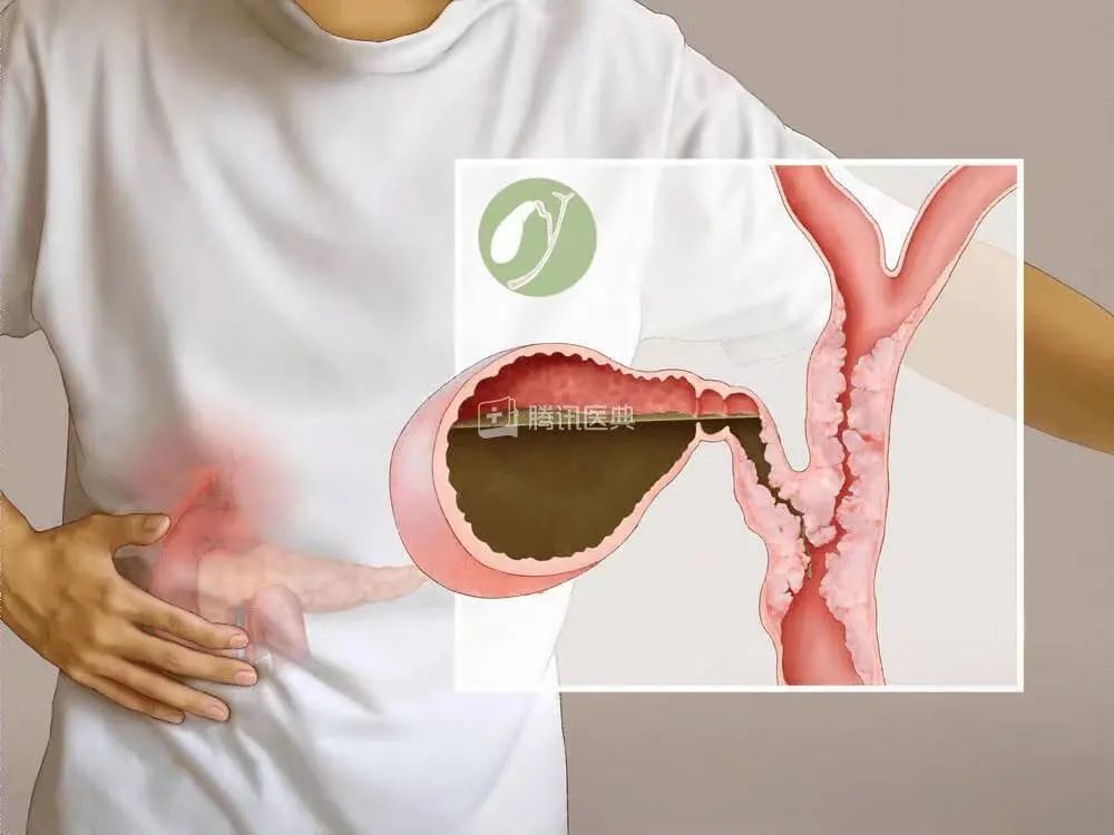 把肝脏取出来,把肝取出来会怎么样