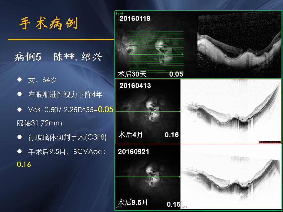 高度近视黄斑劈裂哪家医院好,高度近视黄斑劈裂中医治疗