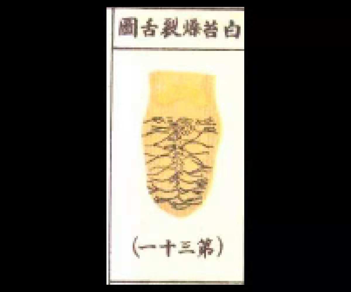 白苔主热症还是寒症,白苔裂纹舌吃什么中成药