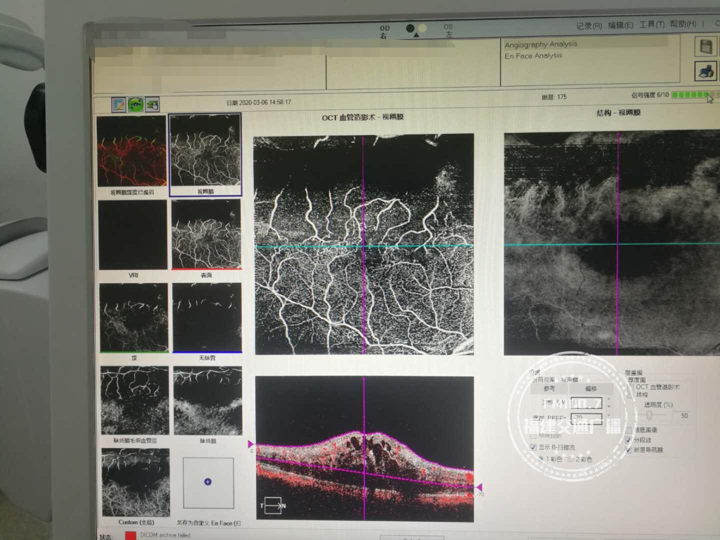 鐐掕偂杩炵画浜忔崯褰诲闅剧湢,鐐掕偂浜忔崯澶╁ぉ澶辩湢