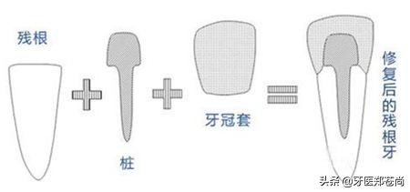 蛀牙已经烂空了只剩下牙根多少钱,蛀牙补好后牙根疼怎么办