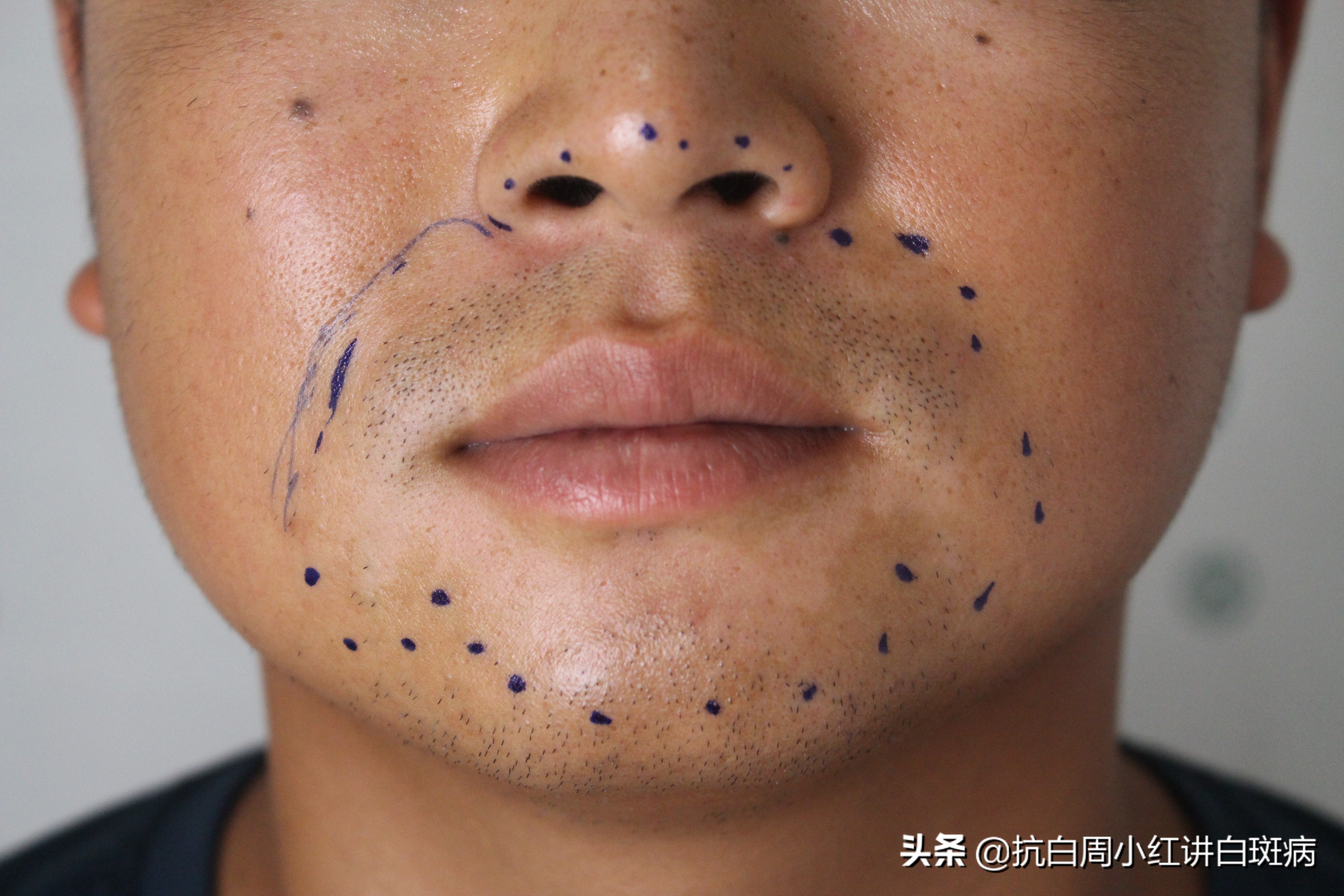 用实际康复案例详解白癜风的中医治疗，附治疗视频