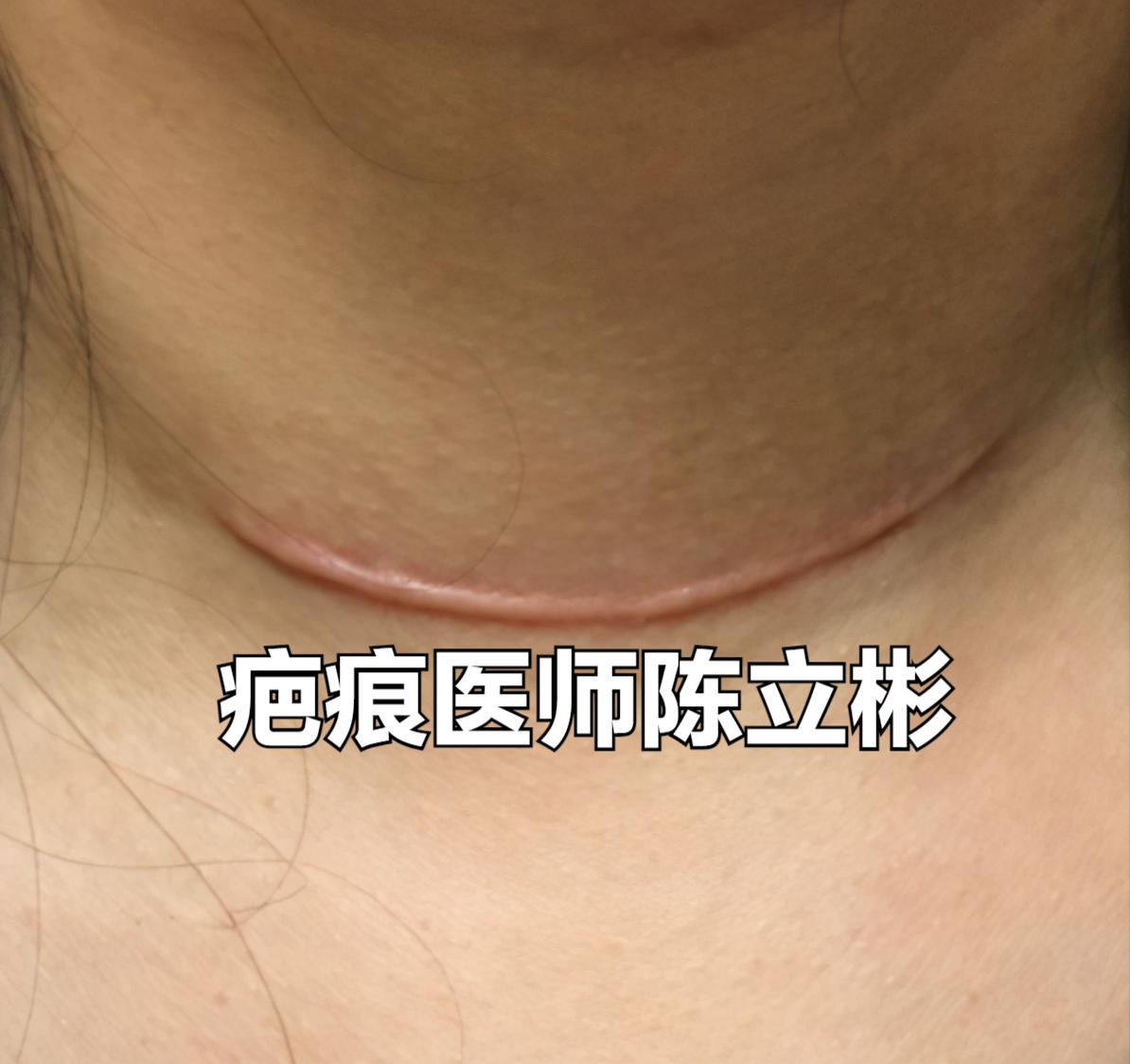 甲状腺结节手术后疤痕,祛甲状腺疤痕的小妙招