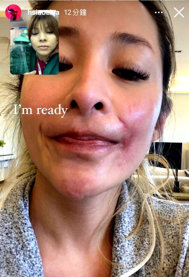 萧亚轩被狗咬伤脸部照片,萧亚轩被狗咬伤脸部怎么修复的