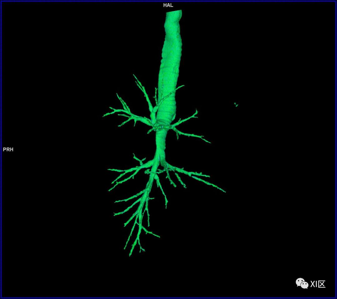 如此详细的肺部影像解剖，有点儿酷