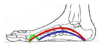矫正鞋垫定制和成品的区别,矫正鞋垫定制方法