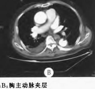 胸部Ct平扫能查出主动脉夹层吗,主动脉夹层cta影像图片解读
