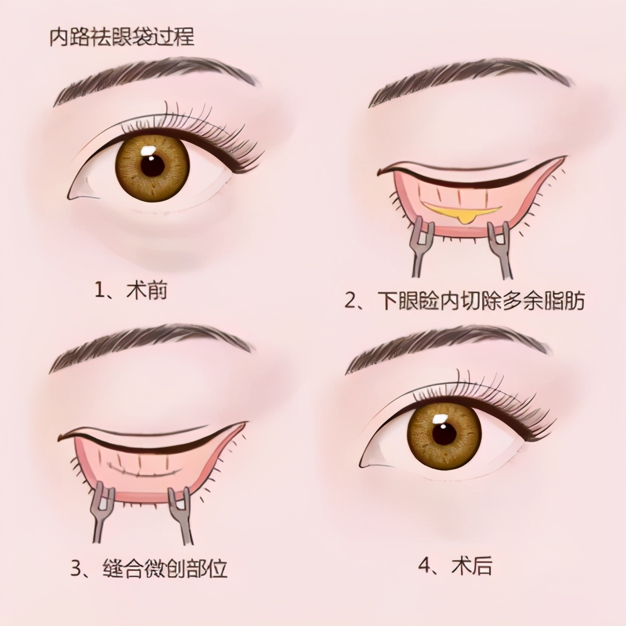 做了内切眼袋手术流泪会很刺痛,做完内切眼袋流眼泪有血