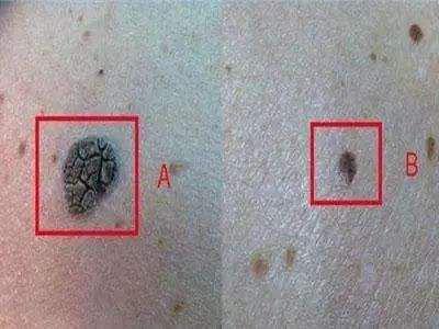 皮肤长出来小疙瘩是什么,皮肤上长了一个小疙瘩看什么科