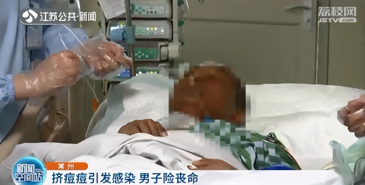 男子挤痘痘住院,男子挤痘痘引发肺部严重感染