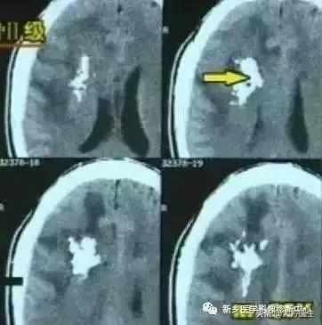 钙化灶是良性肿瘤的可能性大吗,颅内肿瘤钙化发生率最高