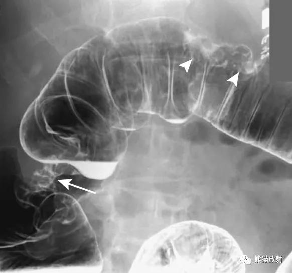 腹部影像图片大全,乙状直肠疼痛位置图片