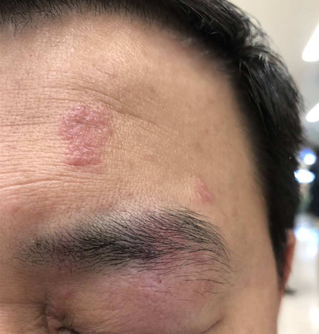 春节假期后出现带状疱疹,春节期间得疱疹的原因