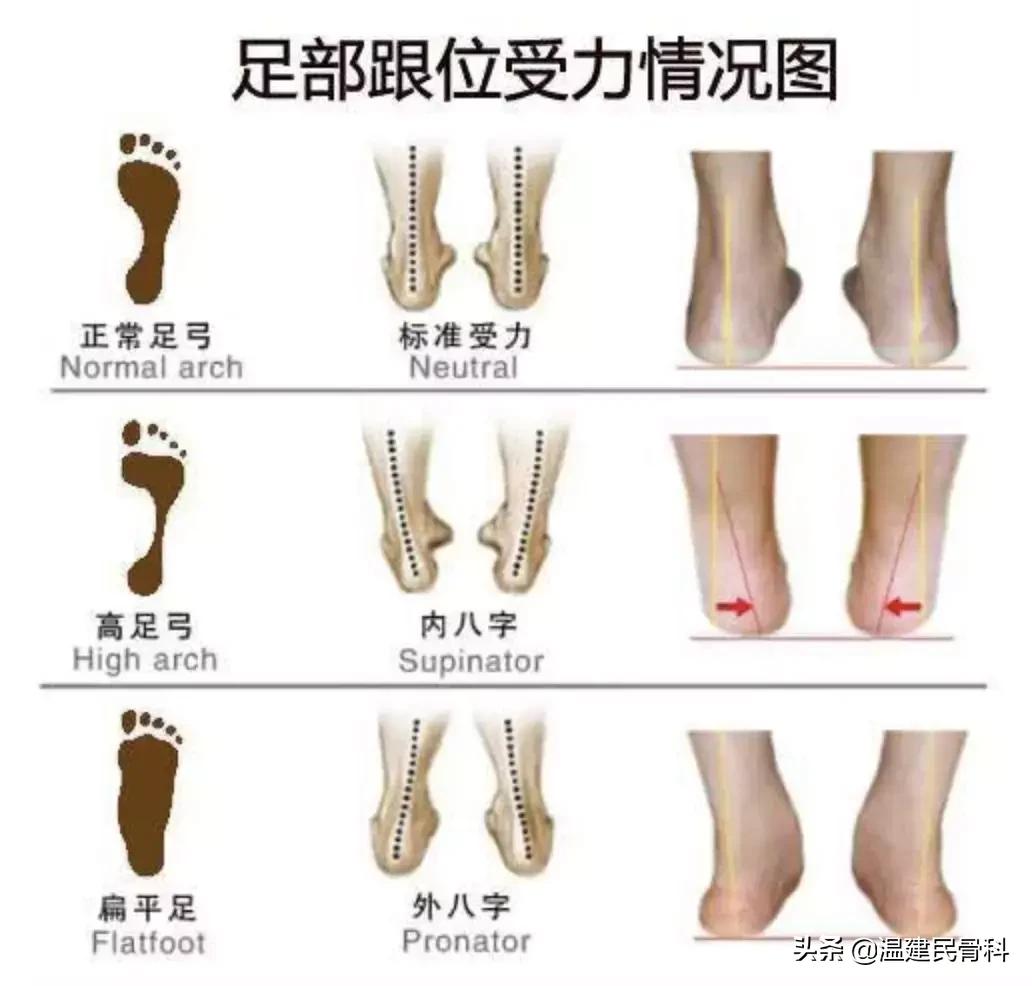 小孩扁平足已经影响走路了怎么办,多大孩子可以判断是扁平足