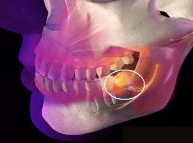 拔牙几天之后就不用担心干槽症了,拔牙之后很疼干槽症