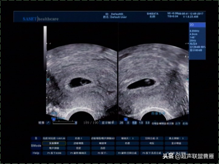 内见卵黄囊,卵黄囊肿瘤