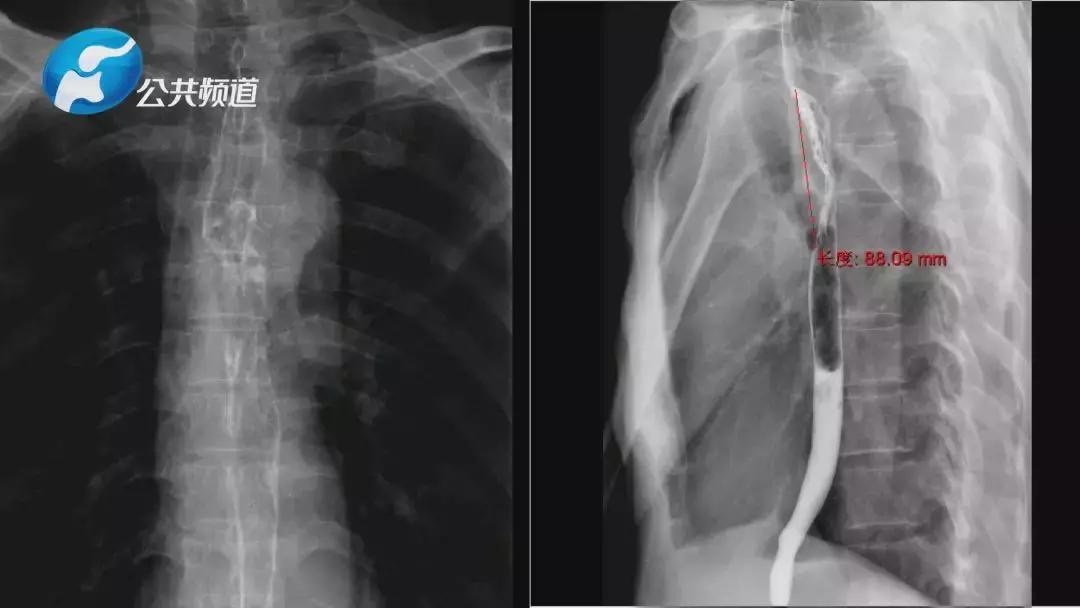 拼搏亮剑|河南大学第一附属医院胸腔镜辅助食管癌根治横结肠代食管手术纪实
