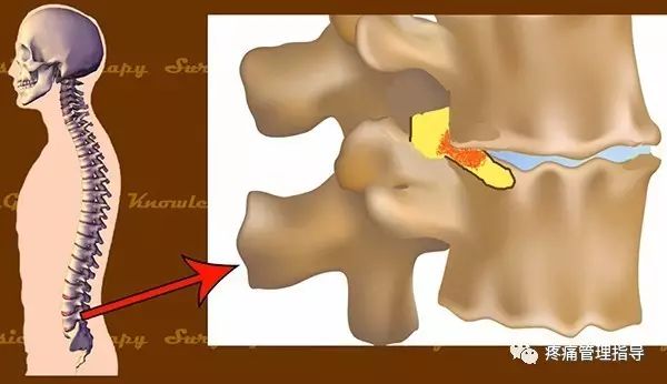 72岁老人腰疼还有骨刺该怎么治疗,老年人骨刺疼痛怎么治疗