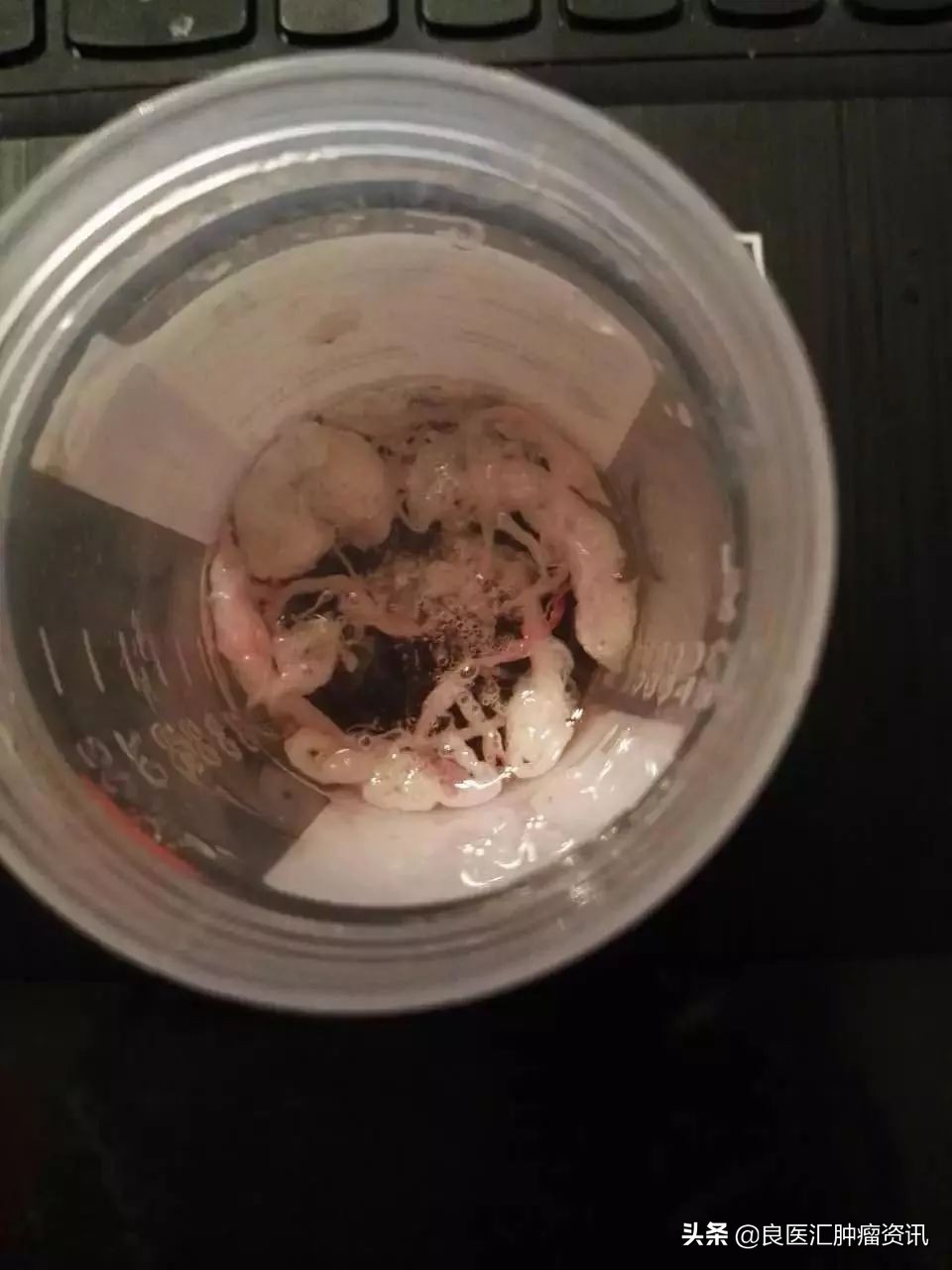 我在美国治肺癌,在美国治疗肺癌的亲身经历