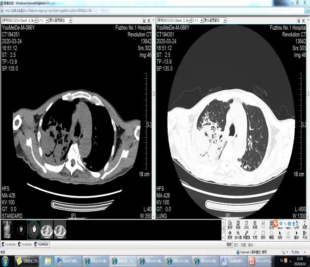 和肺癌比较像的肿瘤,和肺癌一样的肺炎是哪种肺炎