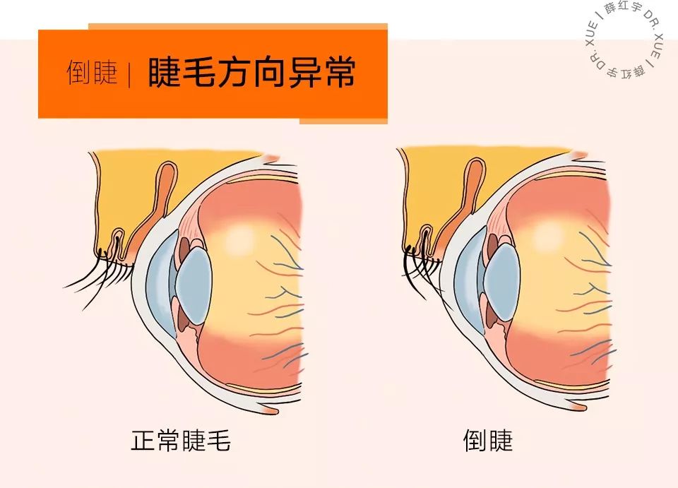 睫毛卷翘的方法半永久,睫毛卷翘定型