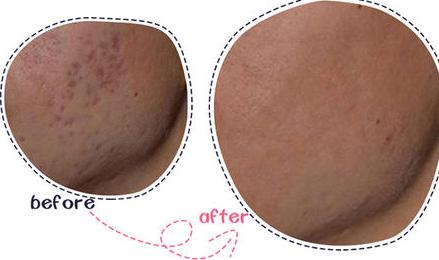 明星超皮秒祛斑,明星皮秒祛斑完整视频