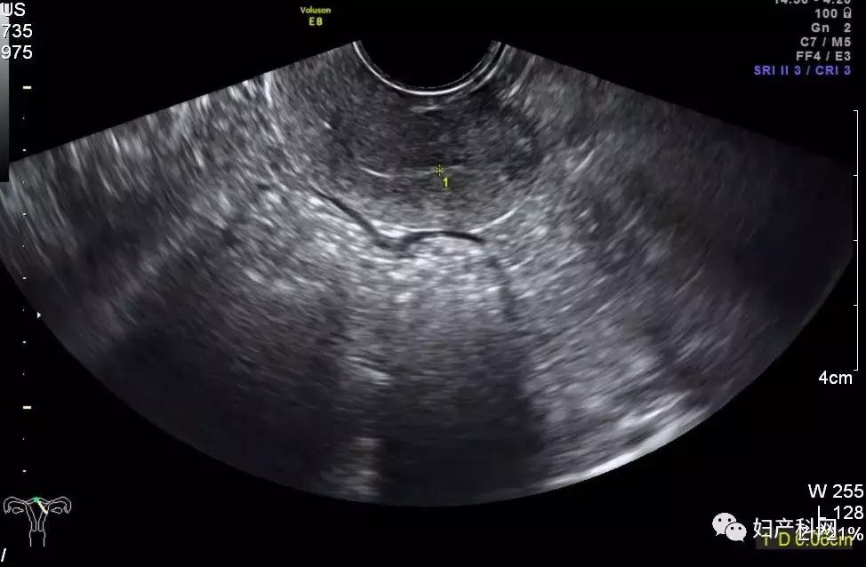 子宫异常出血的病理解剖诊断,产科大出血典型病例分析