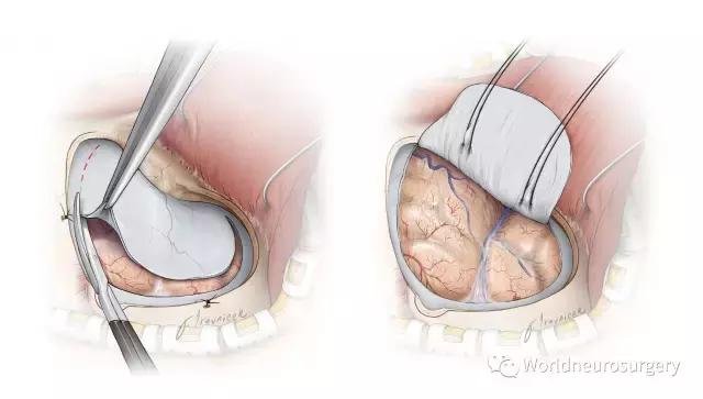翼点入路技巧图解,翼点入路的开颅要点