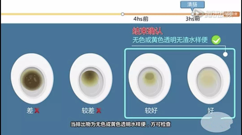 做肠镜之前清肠的亲身经历,清肠几个小时以后做肠镜最合适