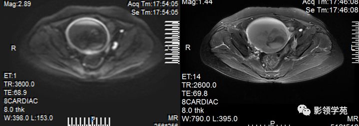 宫颈癌mri诊断,宫颈癌的mr扫描技术
