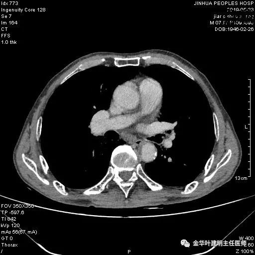 手术引起乳糜胸,有没有做了肺结节手术后是误诊的